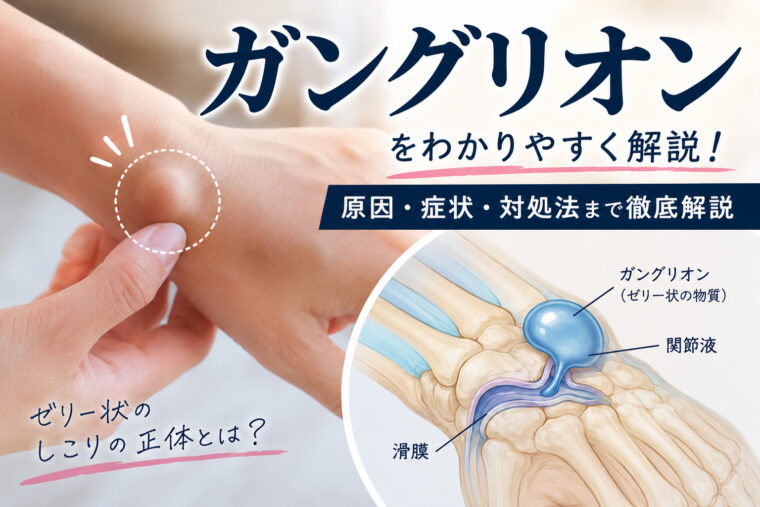 ガングリオン