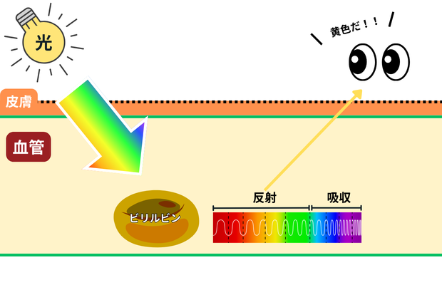 ビリルビンが青を吸収し、黄色を反射する様子の図
