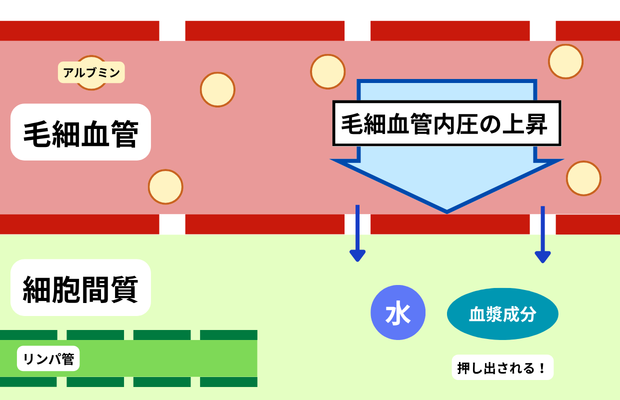 浮腫における毛細血管内圧上昇の図