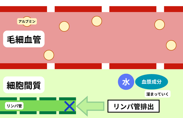 浮腫におけるリンパ排出が出来ていない図